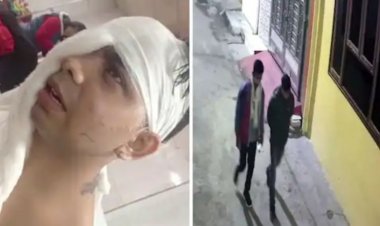 घर में घुसकर मां-बेटे पर एसिड अटैक