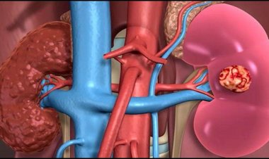 kidney को रखना चाहते हैं स्वस्थ? इन 5 गलतियों से बचें वरना हो सकता है नुकसान